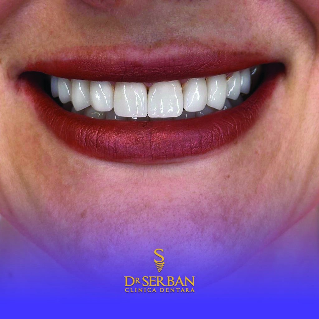 care este cel mai bun implent dentar material