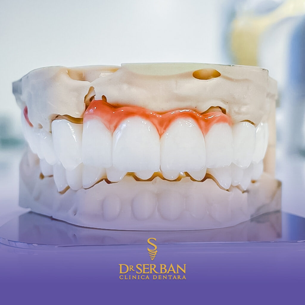 coroana dentară pe implant