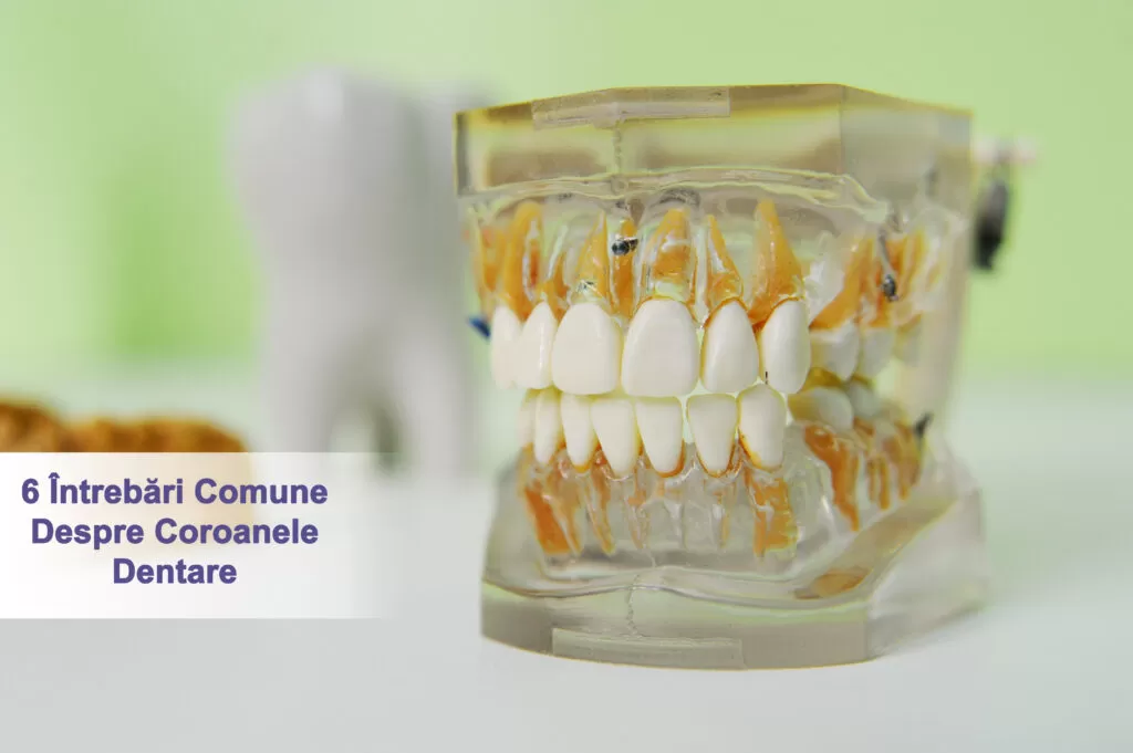 6 întrebări comune despre coroanele dentare