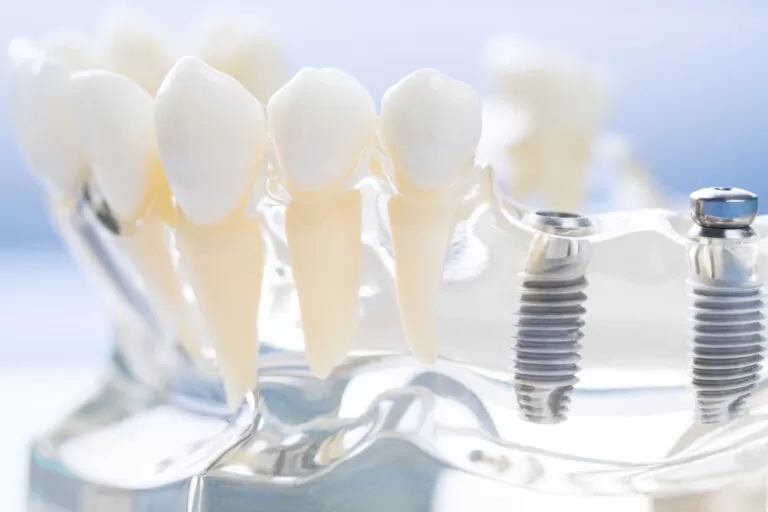 Care sunt indicațiile și contraindicațiile unui implant dentar