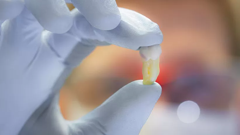 Extracție Molar Minte