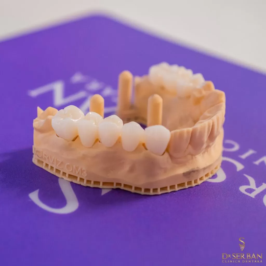 Coroane Dentare Bucuresti Sector 1