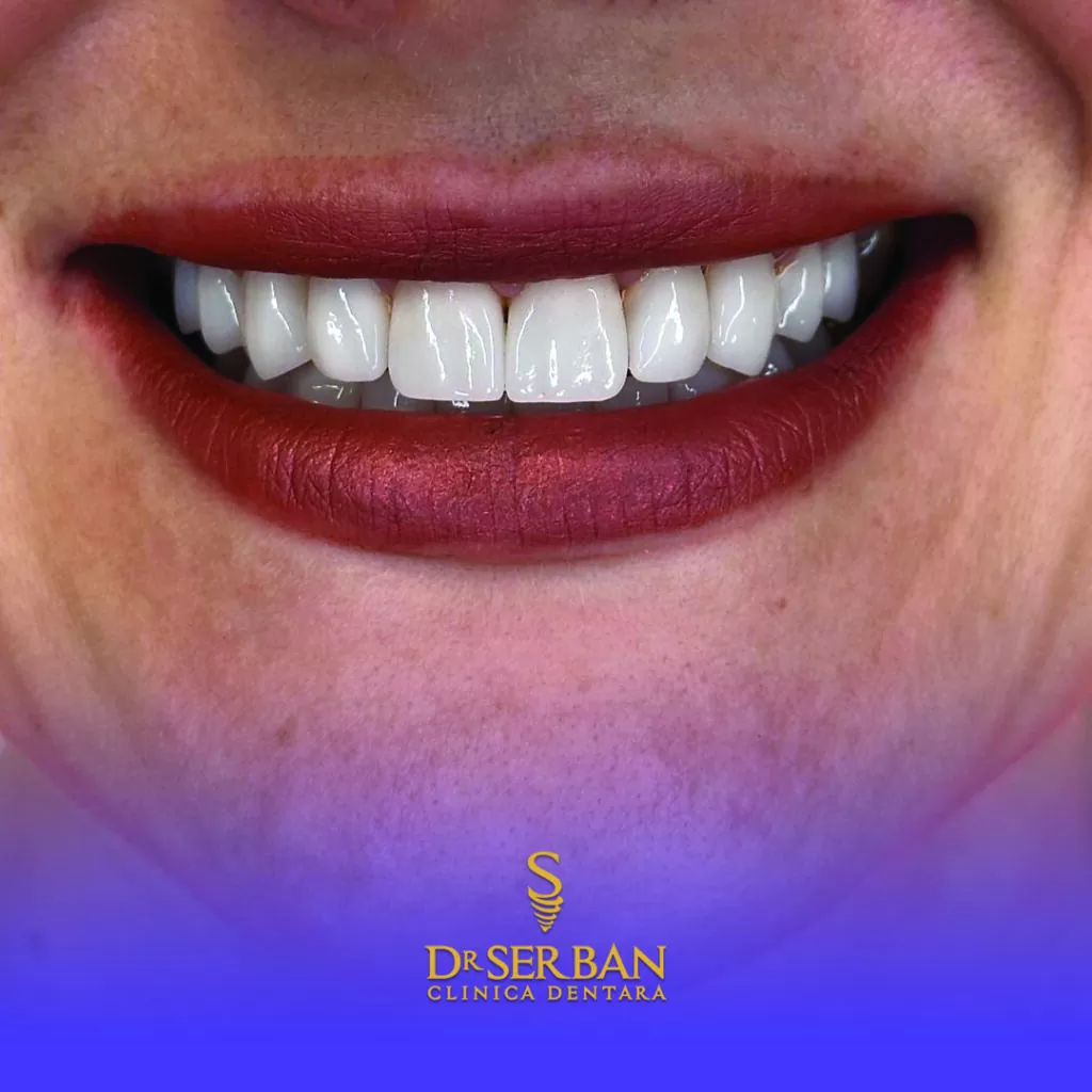 când nu se poate face implant dentar
