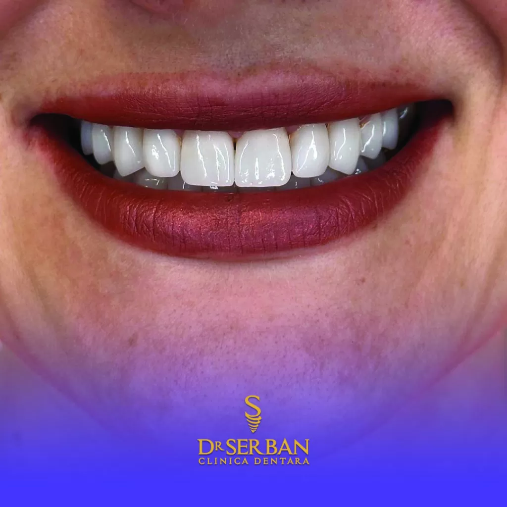 care este cel mai bun implent dentar material