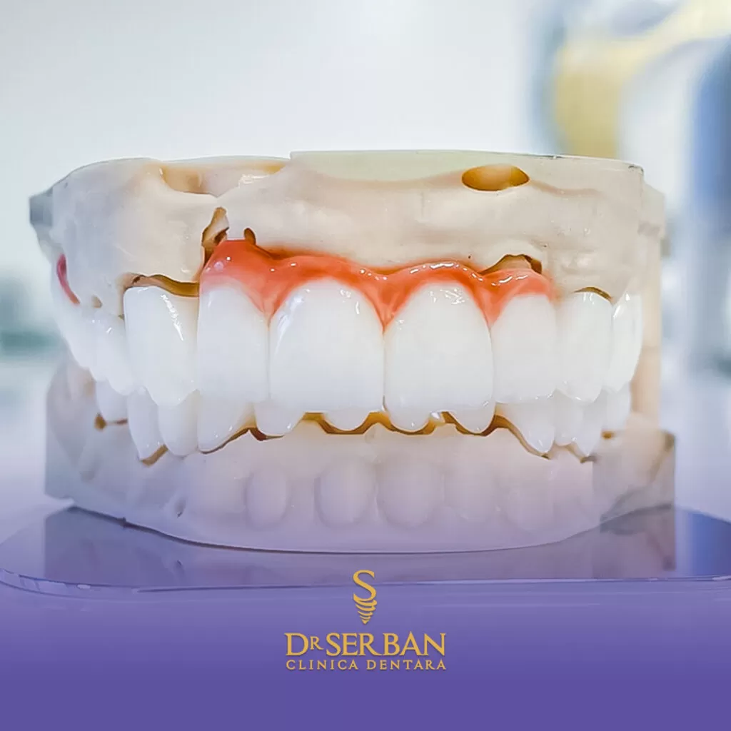 coroana dentară pe implant