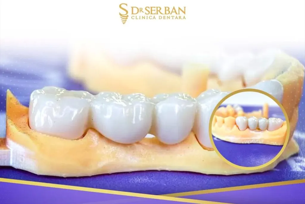 coroana-dentara-la-drserban