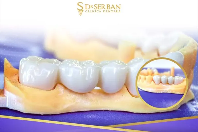 coroana-dentara-la-drserban